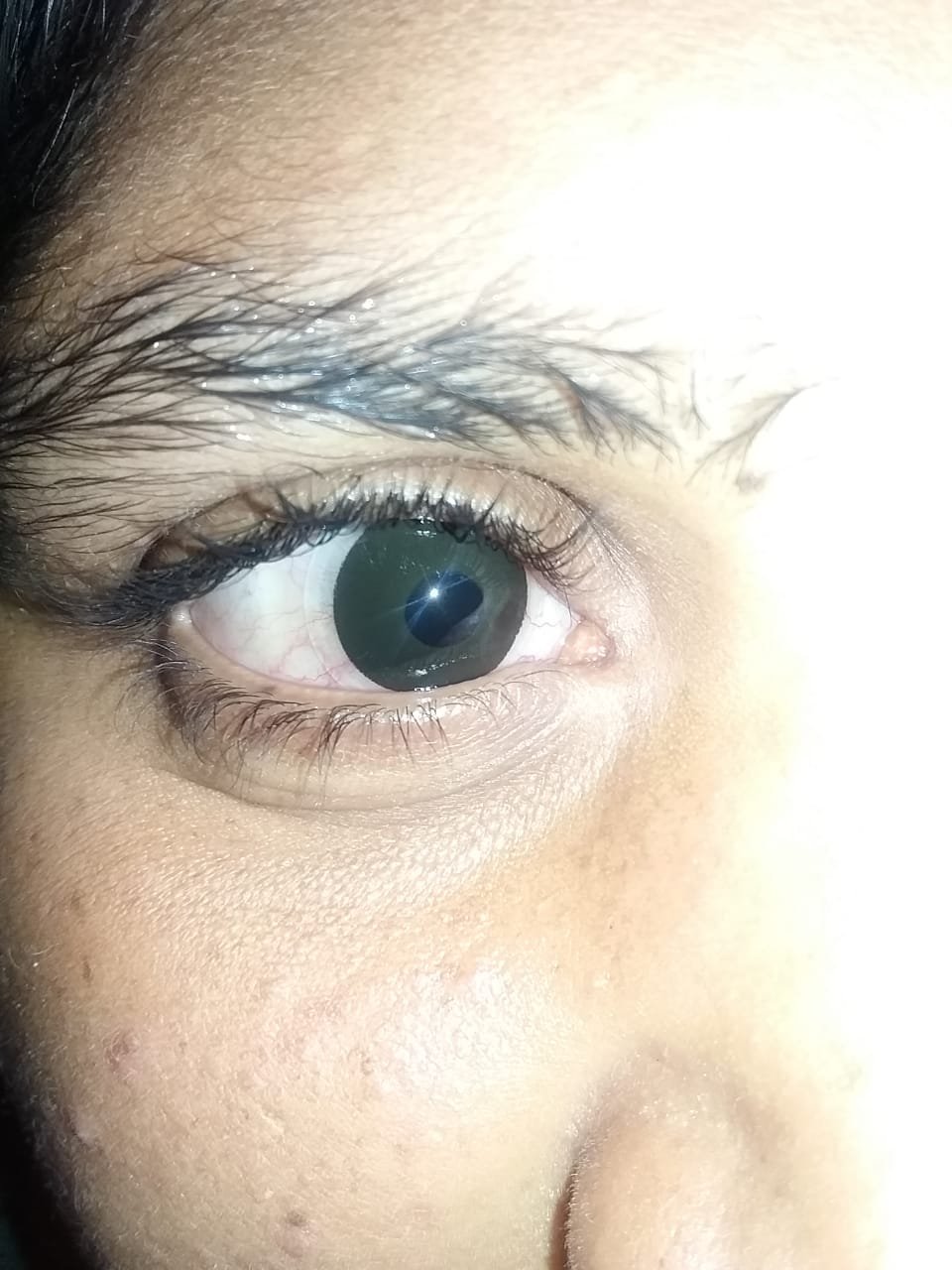 The same eye with a clear pupil after free cataract surgery