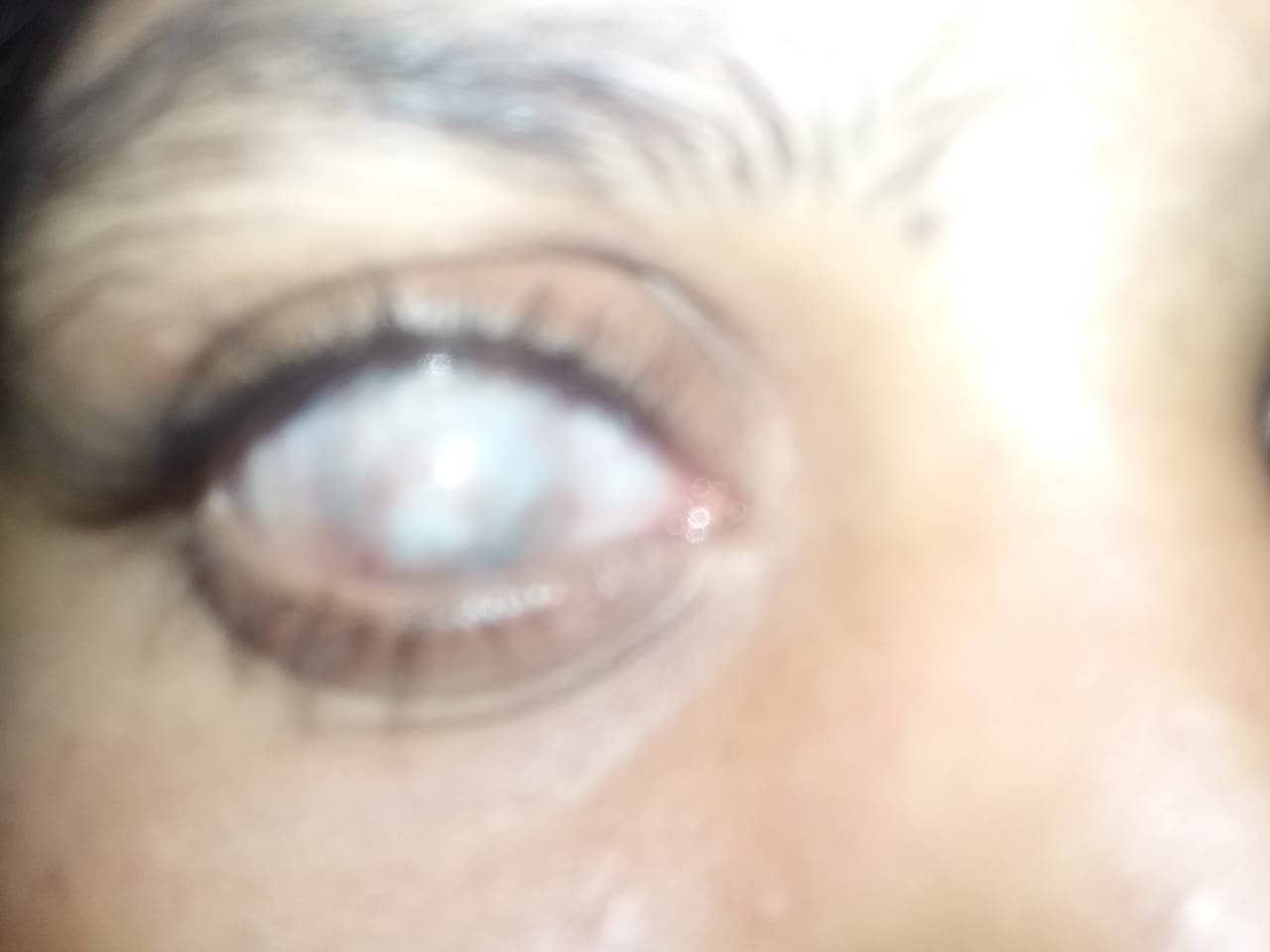 Eye clouded by a dense white cataract before surgery